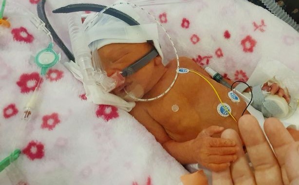 Kirsty Mizon segura a mão de sua pequena Lacey, que tem desafiado as probabilidades, ao lutar por sua vida. (Foto: Burton Mail/ Kirsty Mizon)