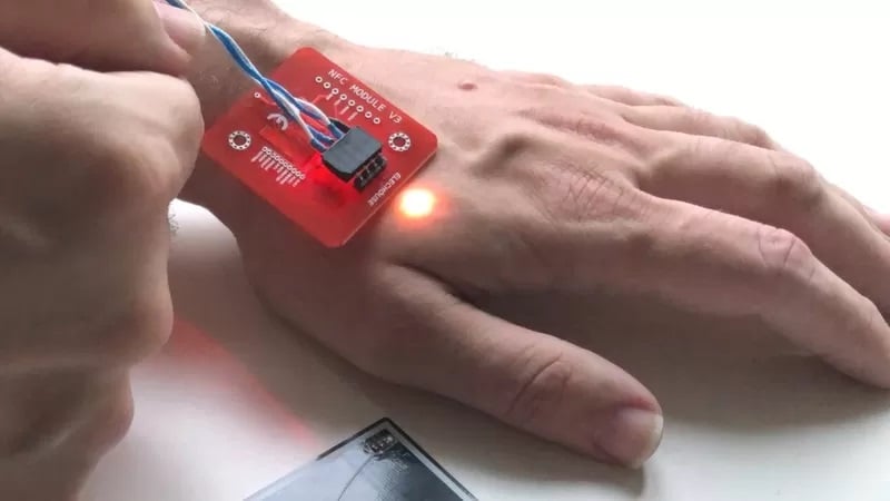 Um raio-x mostra um implante Walletmor, que é injetado na mão de uma pessoa após um anestésico local. (Foto: Reprodução / BBC)