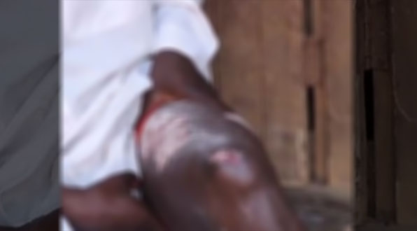 Yusufu mostra queimaduras de terceiro grau em uma das pernas. (Foto: Reprodução/Morning Star News)