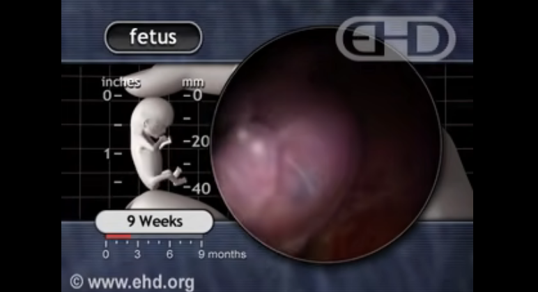 Imagens mostram que pílula abortiva mata feto de 9 semanas já formado