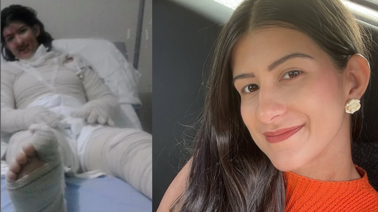 Mulher sobrevive após ter 60% do corpo queimado: 