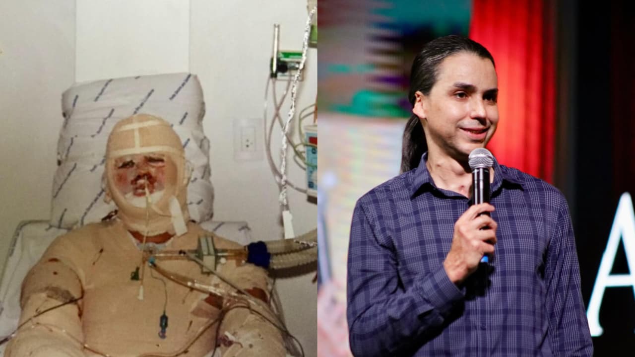 Homem desenganado com 40% do corpo queimado sobrevive: “Estou vivo para glória de Deus”